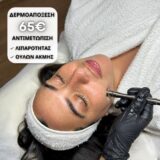 Microdermabrasion Offer ή αλλιώς Δερμοαπόξεση στα 65€!